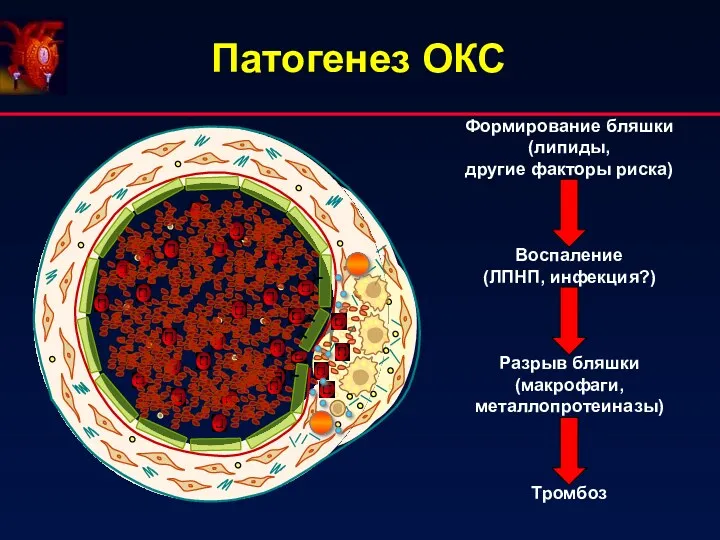 Патогенез ОКС Формирование бляшки (липиды, другие факторы риска) Воспаление (ЛПНП, инфекция?) Разрыв бляшки (макрофаги, металлопротеиназы) Тромбоз