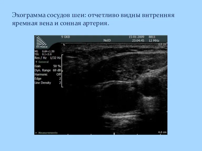 Эхограмма сосудов шеи: отчетливо видны внтренняя яремная вена и сонная артерия.