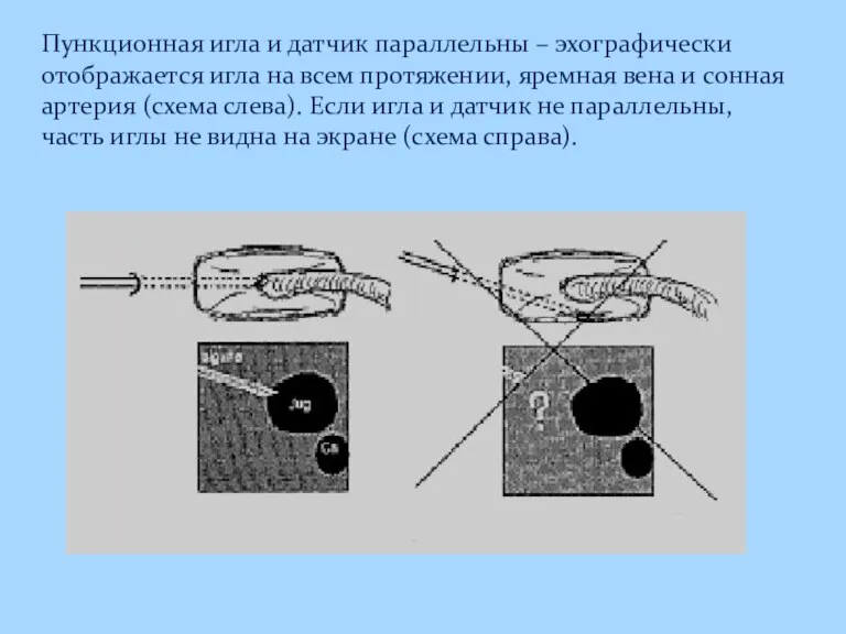 Пункционная игла и датчик параллельны – эхографически отображается игла на