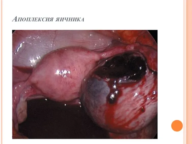 Апоплексия яичника
