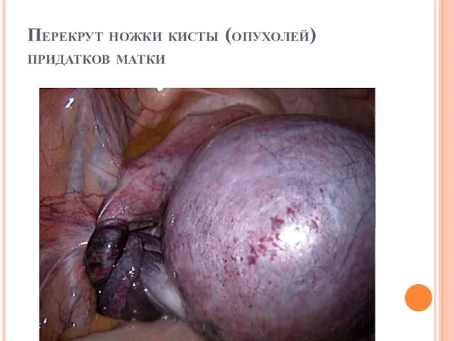 Перекрут ножки кисты (опухолей) придатков матки