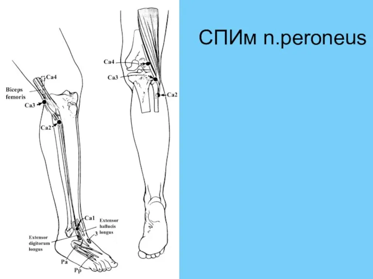 СПИм n.peroneus