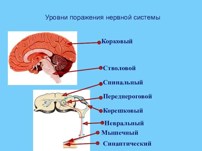 Уровни поражения нервной системы Корковый Спинальный Переднероговой Корешковый Невральный Синаптический Стволовой Мышечный