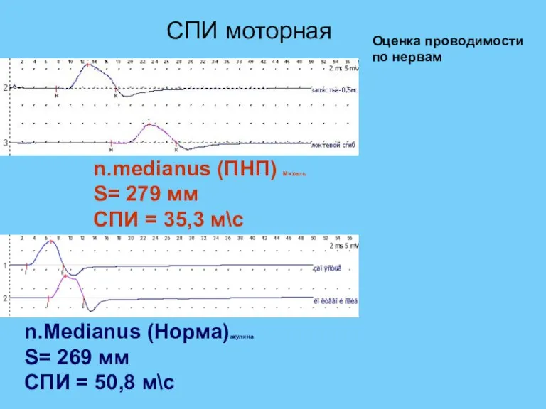 СПИ моторная n.medianus (ПНП) Михель S= 279 мм СПИ = 35,3 м\с n.Medianus