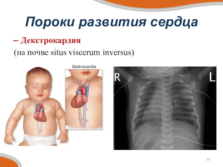 Пороки развития сердца Декстрокардия (на почве situs viscerum inversus)