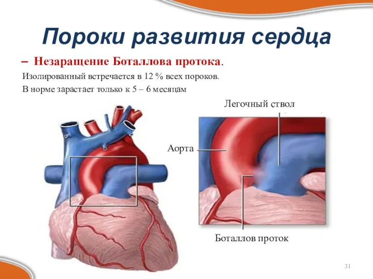 Пороки развития сердца Незаращение Боталлова протока. Изолированный встречается в 12 % всех пороков.