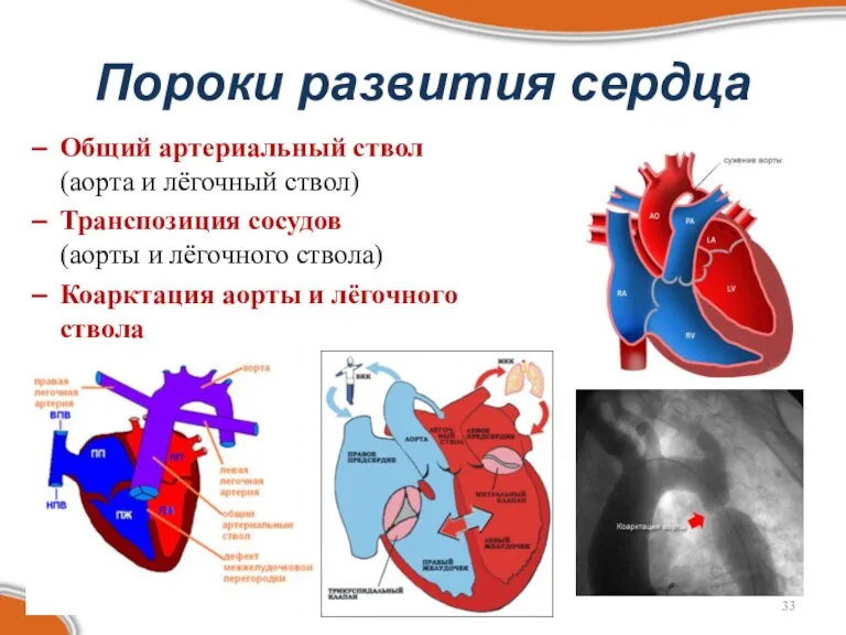 Пороки развития сердца Общий артериальный ствол (аорта и лёгочный ствол) Транспозиция сосудов (аорты