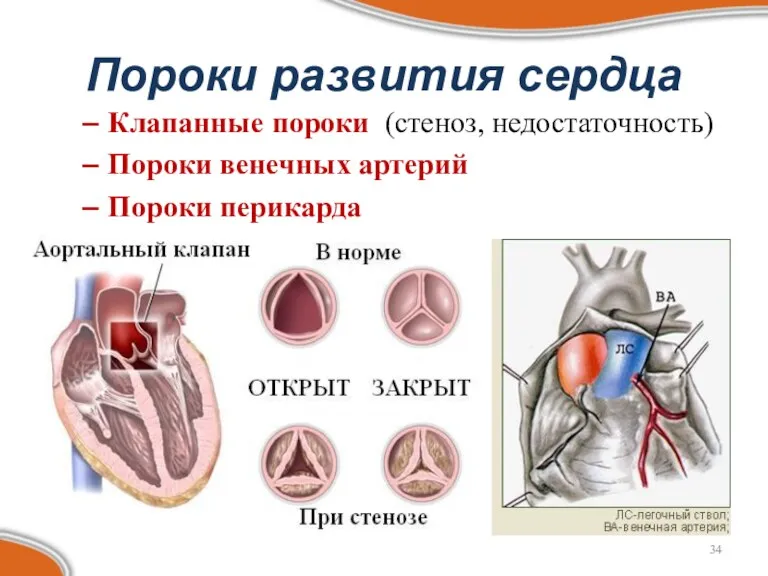 Пороки развития сердца Клапанные пороки (стеноз, недостаточность) Пороки венечных артерий Пороки перикарда