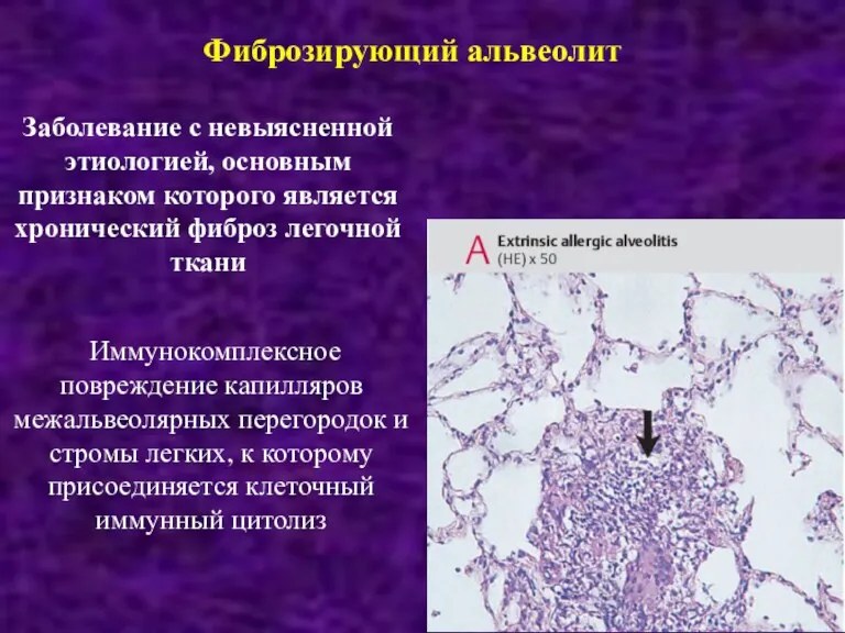 Заболевание с невыясненной этиологией, основным признаком которого является хронический фиброз легочной ткани Иммунокомплексное