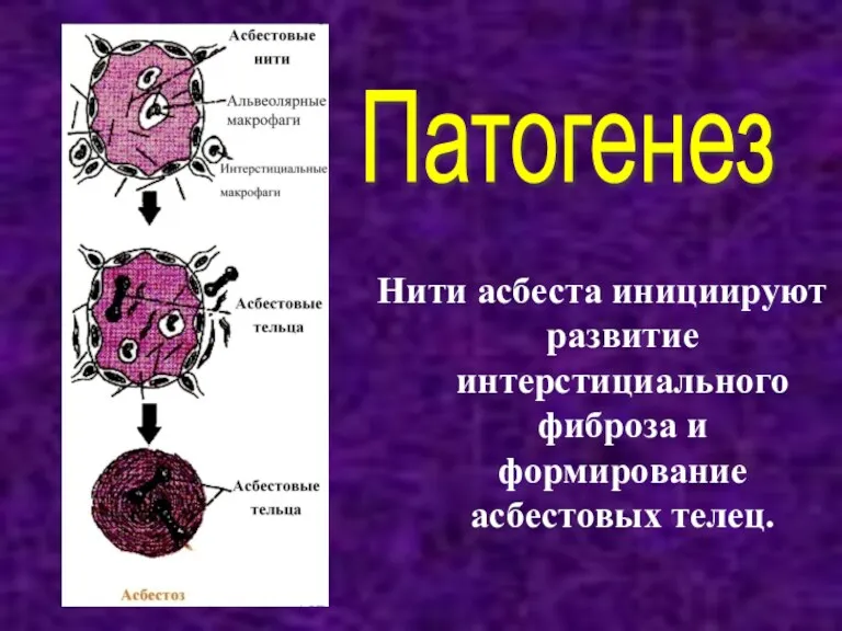 Нити асбеста инициируют развитие интерстициального фиброза и формирование асбестовых телец. Патогенез