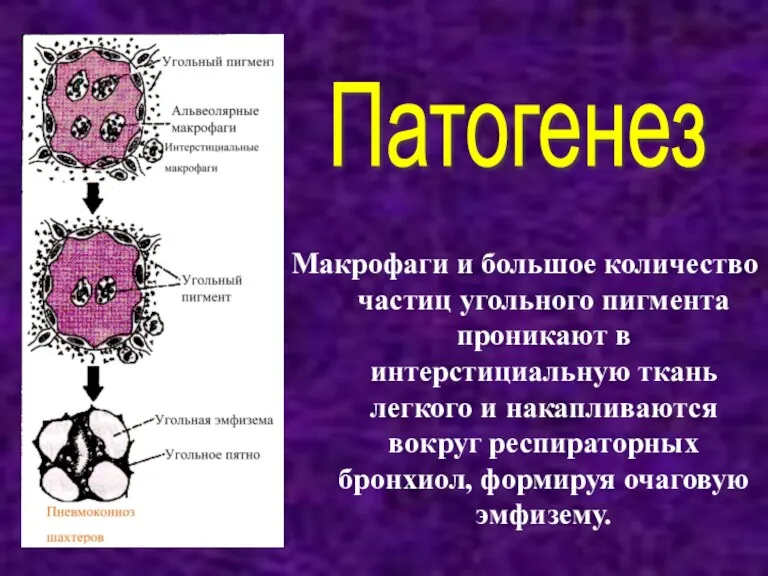 Макрофаги и большое количество частиц угольного пигмента проникают в интерстициальную