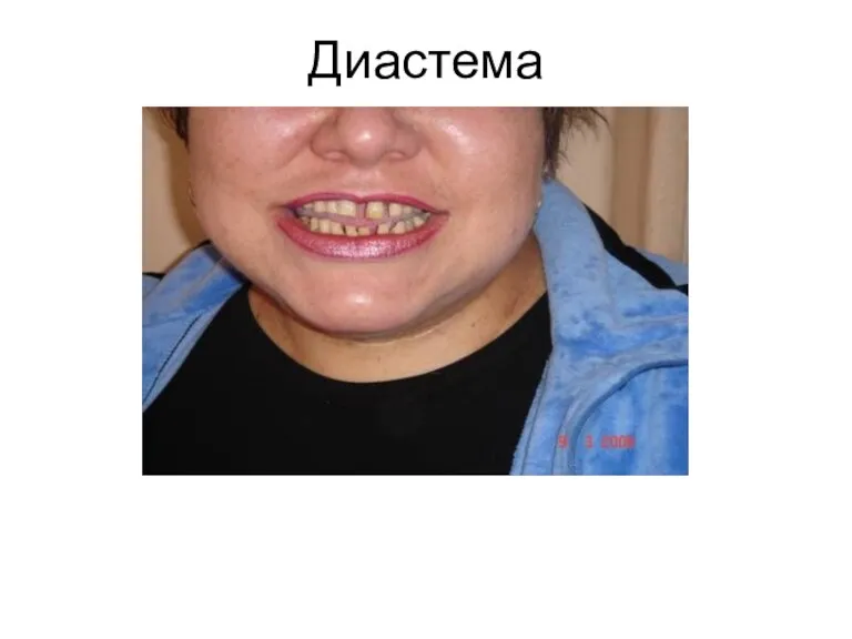 Диастема