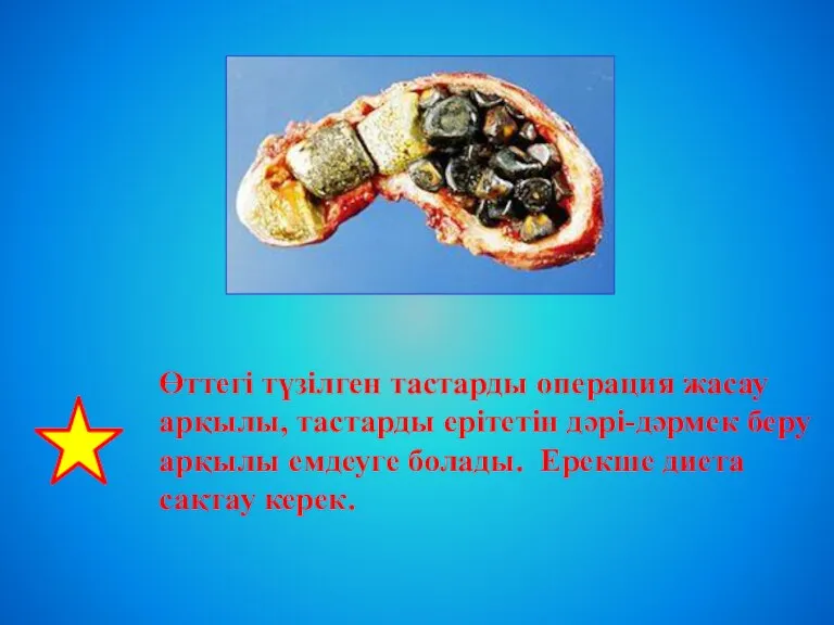 Өттегі түзілген тастарды операция жасау арқылы, тастарды ерітетін дәрі-дәрмек беру