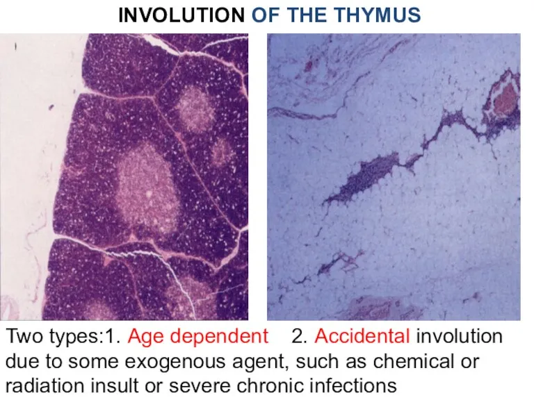 INVOLUTION OF THE THYMUS Two types:1. Age dependent 2. Accidental