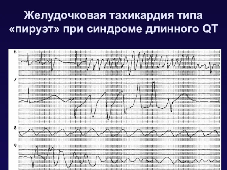 Желудочковая тахикардия типа «пируэт» при синдроме длинного QT