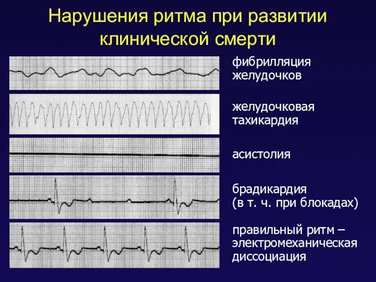 Нарушения ритма при развитии клинической смерти