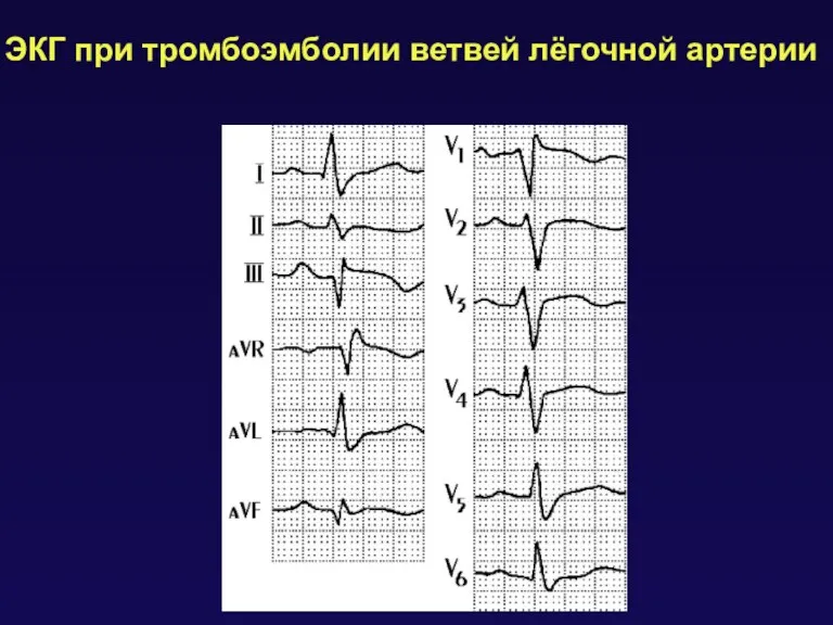 ЭКГ при тромбоэмболии ветвей лёгочной артерии