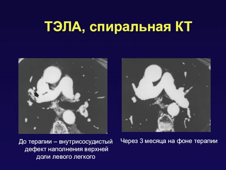 ТЭЛА, спиральная КТ