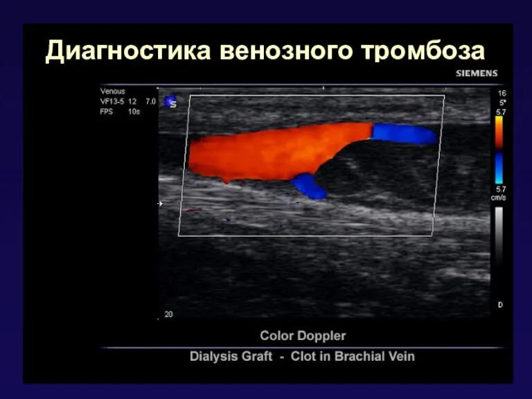 Диагностика венозного тромбоза
