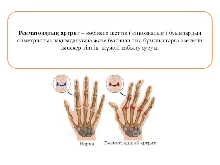 Ревматоидтық артрит – көбінесе шеттік ( синовиялық ) буындардың симетриялық