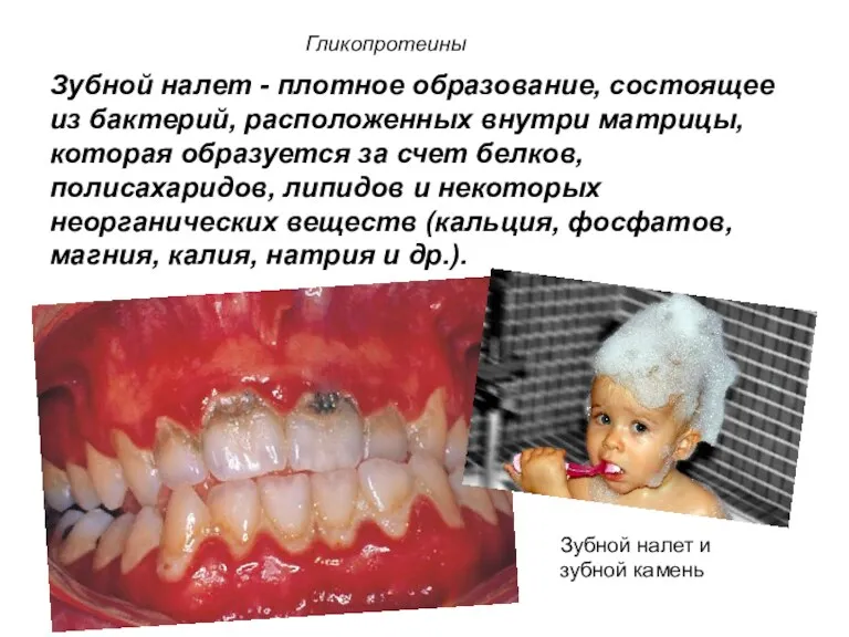 Зубной налет - плотное образование, состоящее из бактерий, расположенных внутри