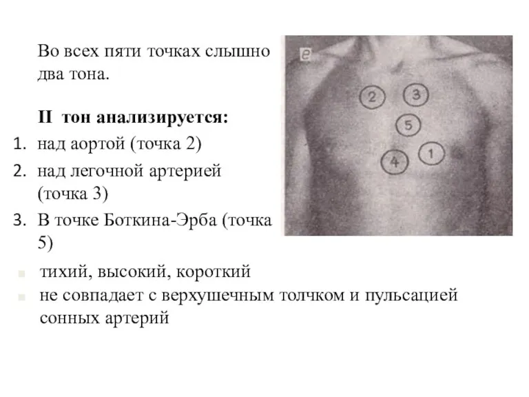 Во всех пяти точках слышно два тона. II тон анализируется: