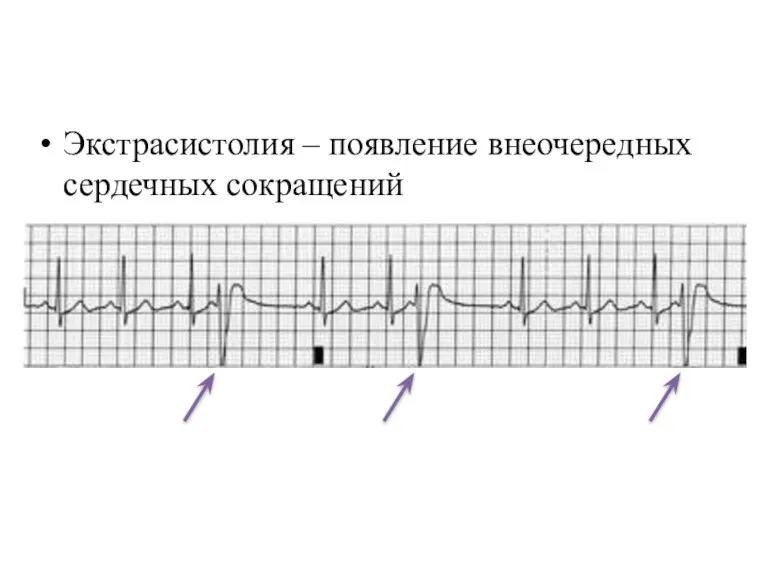 Экстрасистолия – появление внеочередных сердечных сокращений