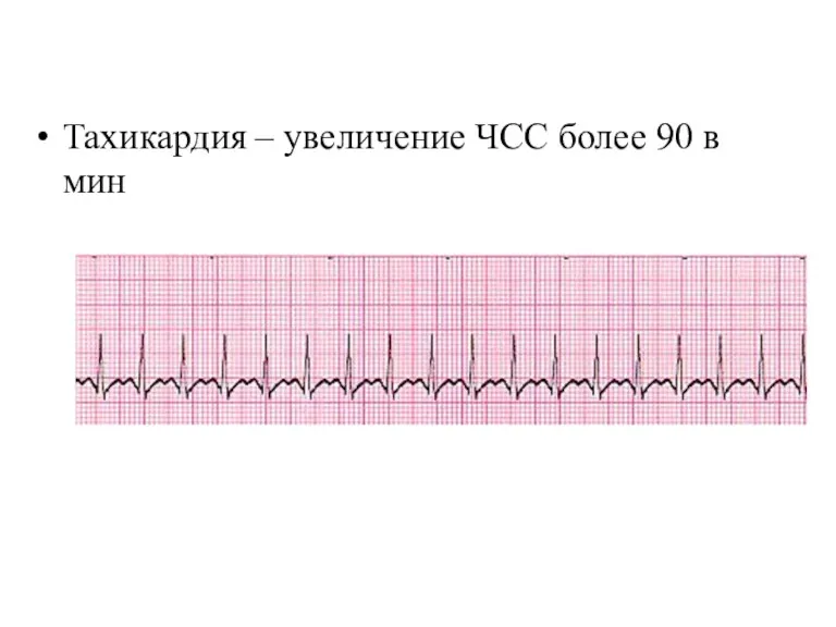 Тахикардия – увеличение ЧСС более 90 в мин