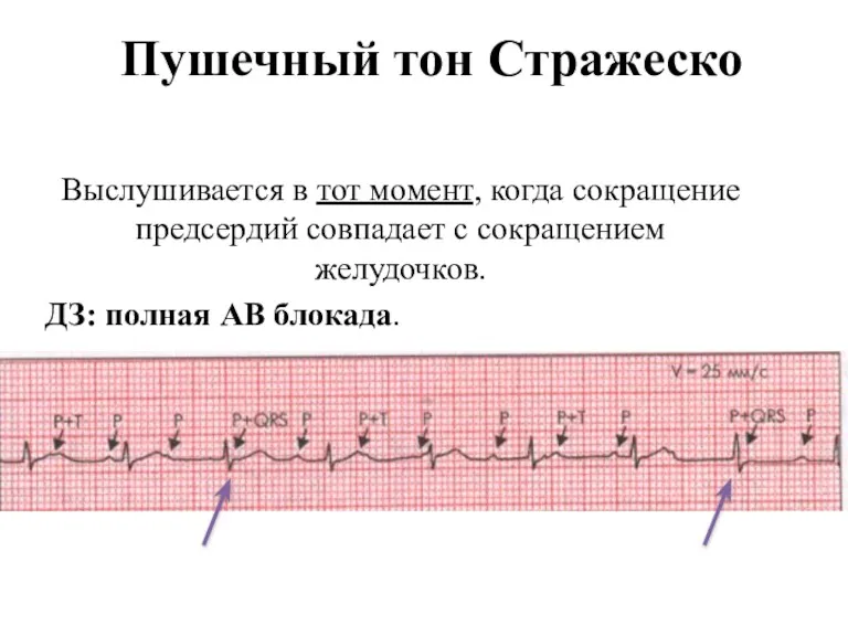 Пушечный тон Стражеско Выслушивается в тот момент, когда сокращение предсердий