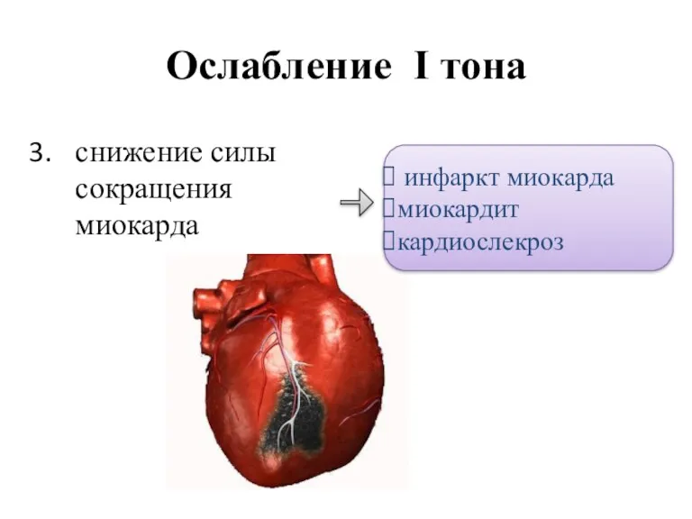 Ослабление I тона снижение силы сокращения миокарда инфаркт миокарда миокардит кардиослекроз