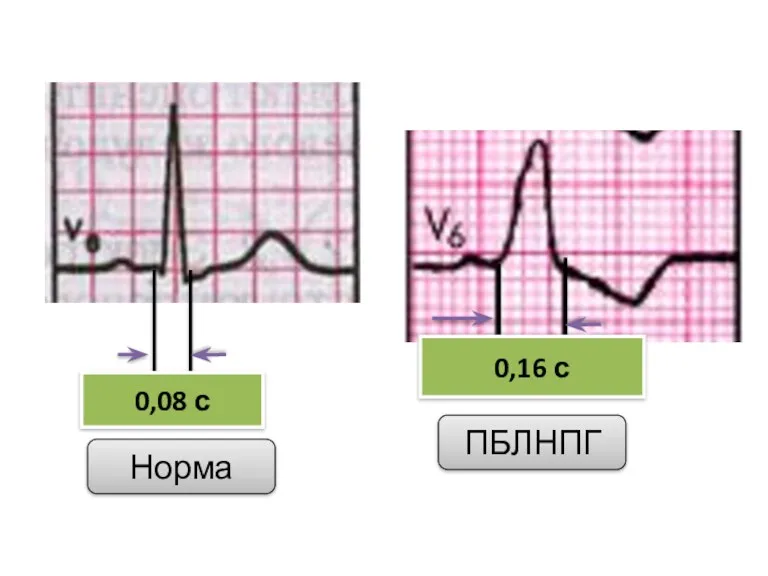 0,08 с 0,16 с ПБЛНПГ Норма