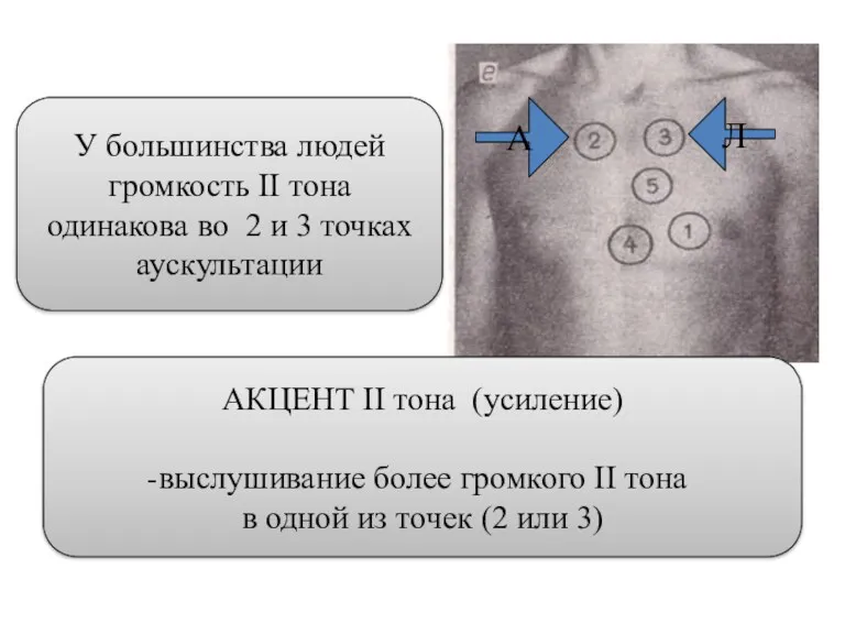 АКЦЕНТ II тона (усиление) выслушивание более громкого II тона в