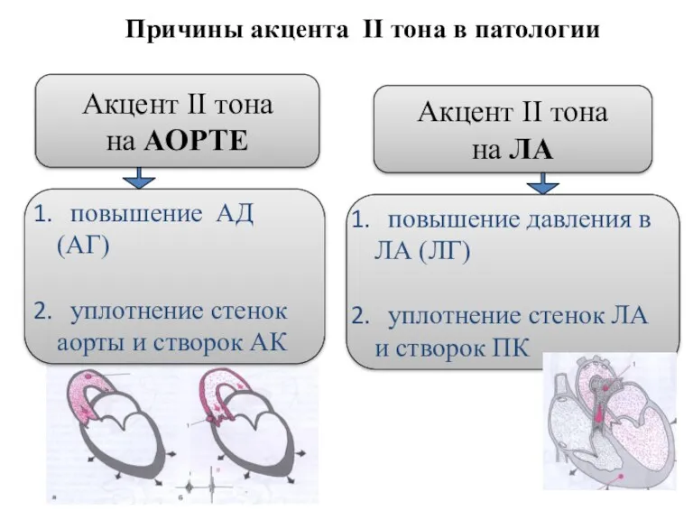 Акцент II тона на АОРТЕ Акцент II тона на ЛА