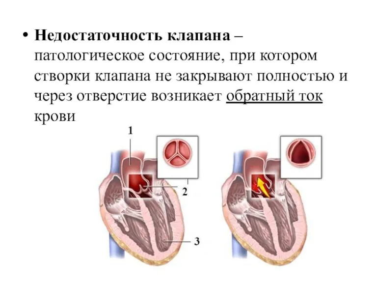 Недостаточность клапана – патологическое состояние, при котором створки клапана не