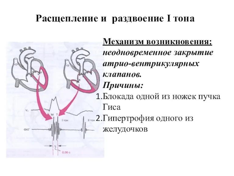 Расщепление и раздвоение I тона Механизм возникновения: неодновременное закрытие атрио-вентрикулярных