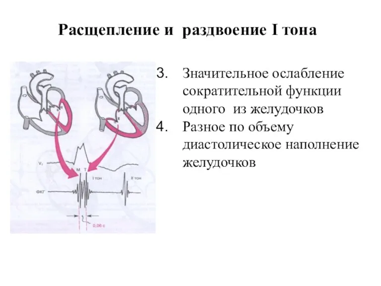 Значительное ослабление сократительной функции одного из желудочков Разное по объему