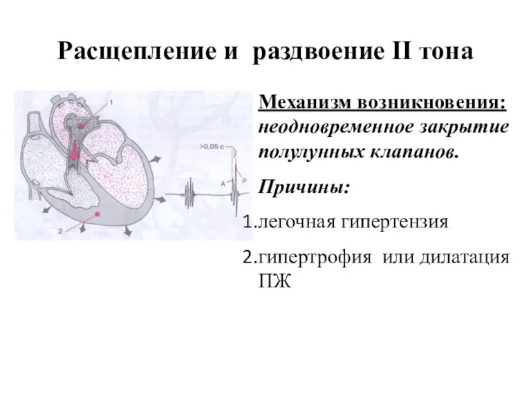 Расщепление и раздвоение II тона Механизм возникновения: неодновременное закрытие полулунных