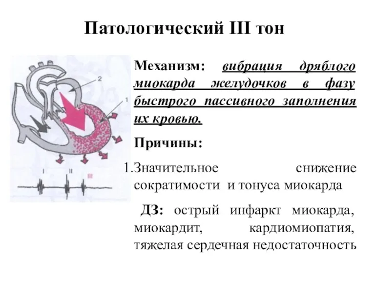 Патологический III тон Механизм: вибрация дряблого миокарда желудочков в фазу