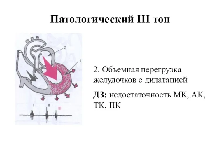 2. Объемная перегрузка желудочков с дилатацией ДЗ: недостаточность МК, АК, ТК, ПК Патологический III тон