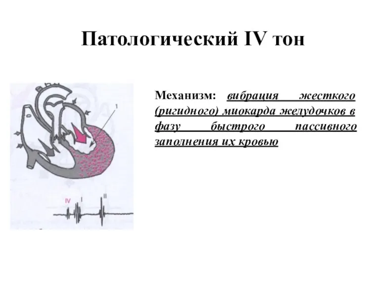 Патологический IV тон Механизм: вибрация жесткого (ригидного) миокарда желудочков в фазу быстрого пассивного заполнения их кровью