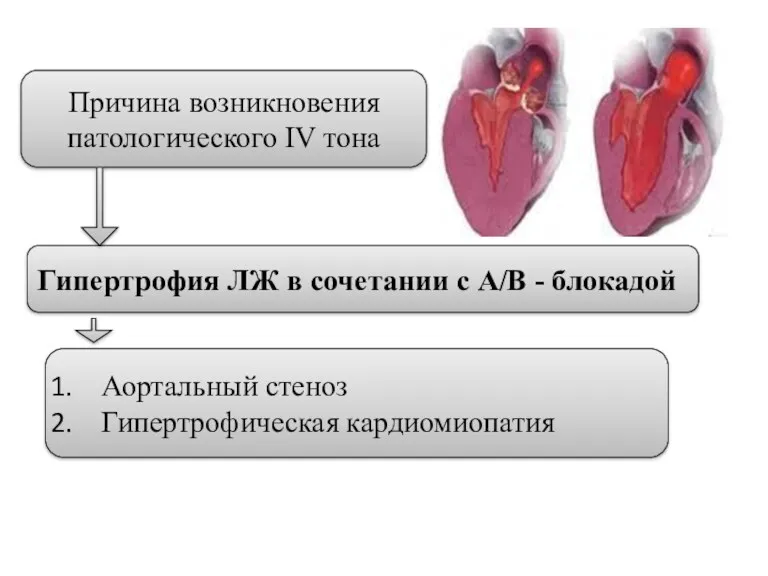 Причина возникновения патологического IV тона Гипертрофия ЛЖ в сочетании с