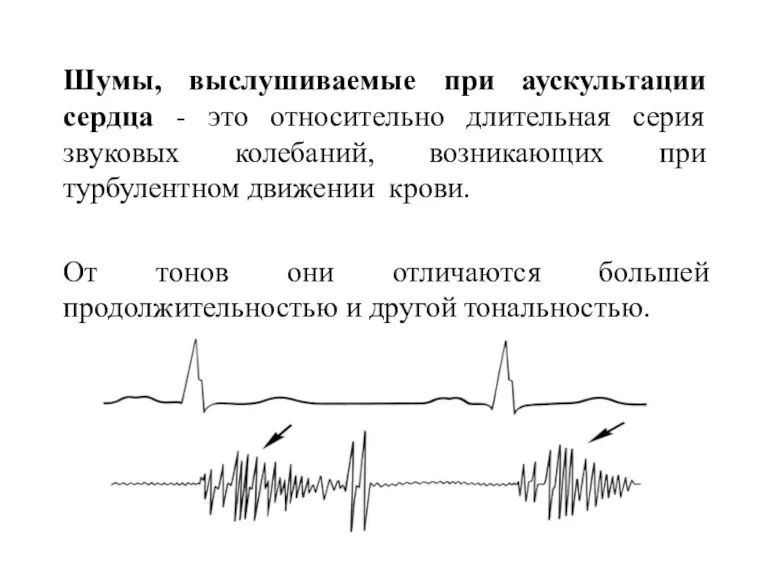 Шумы, выслушиваемые при аускультации сердца - это относительно длительная серия