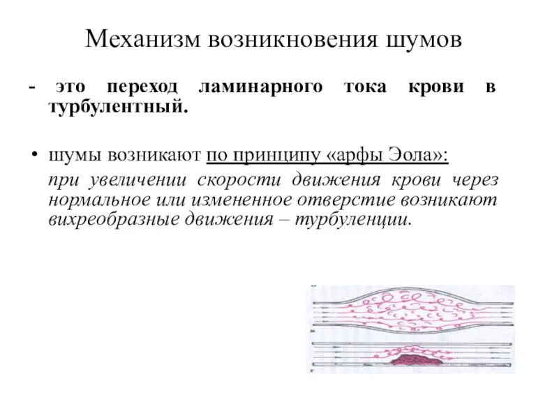 Механизм возникновения шумов - это переход ламинарного тока крови в