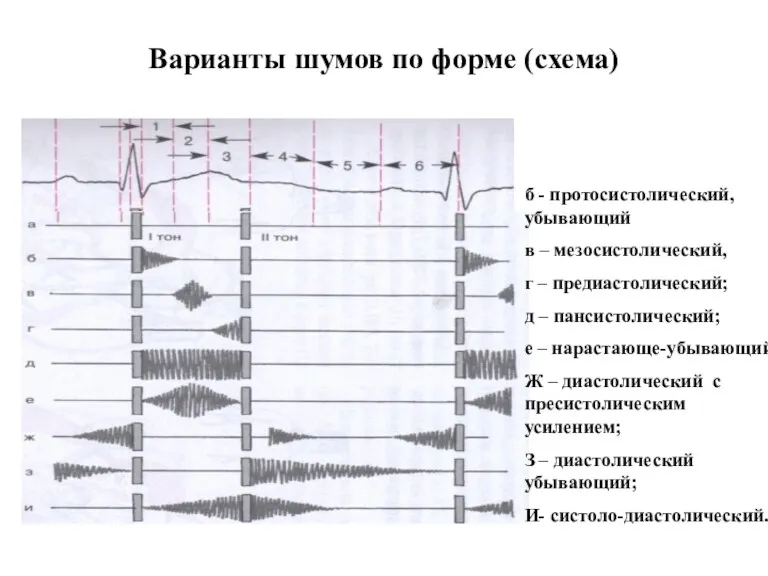 Варианты шумов по форме (схема) б - протосистолический, убывающий в