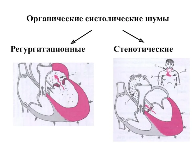 Органические систолические шумы Регургитационные Стенотические