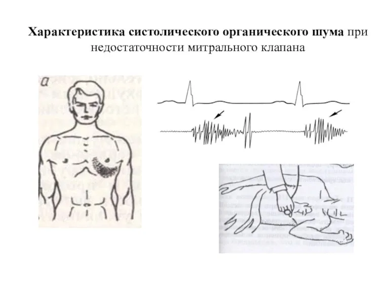 Характеристика систолического органического шума при недостаточности митрального клапана