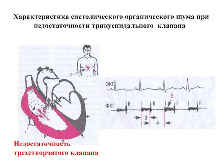 Характеристика систолического органического шума при недостаточности трикуспидального клапана Недостаточность трехстворчатого клапана