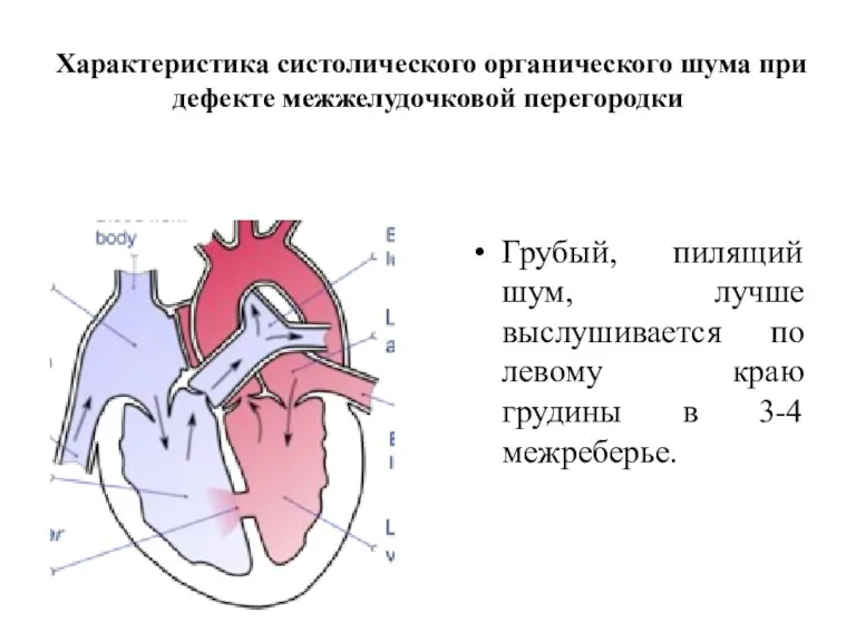 Характеристика систолического органического шума при дефекте межжелудочковой перегородки Грубый, пилящий