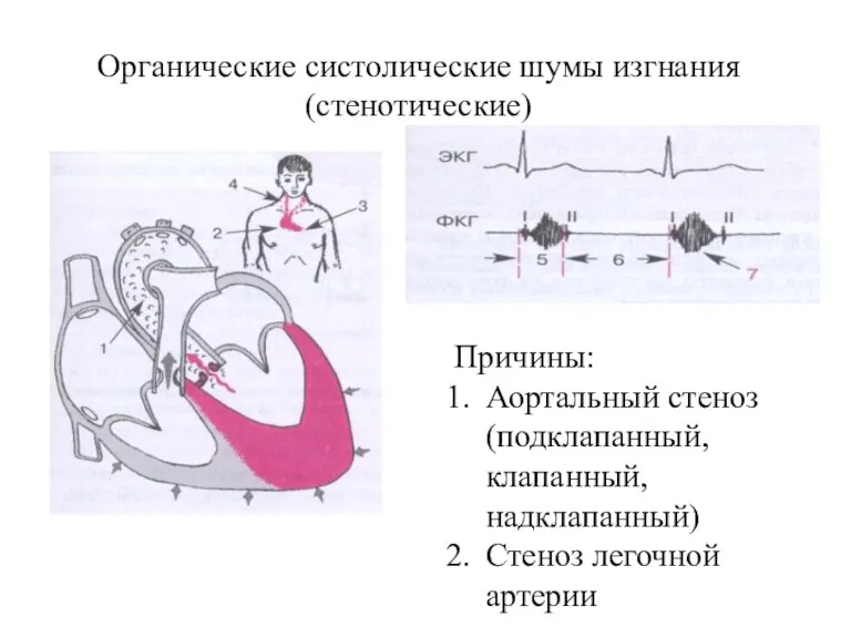 Органические систолические шумы изгнания (стенотические) Причины: Аортальный стеноз (подклапанный, клапанный, надклапанный) Стеноз легочной артерии