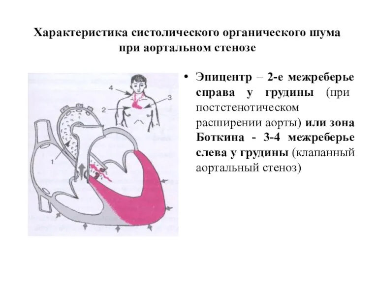 Характеристика систолического органического шума при аортальном стенозе Эпицентр – 2-е